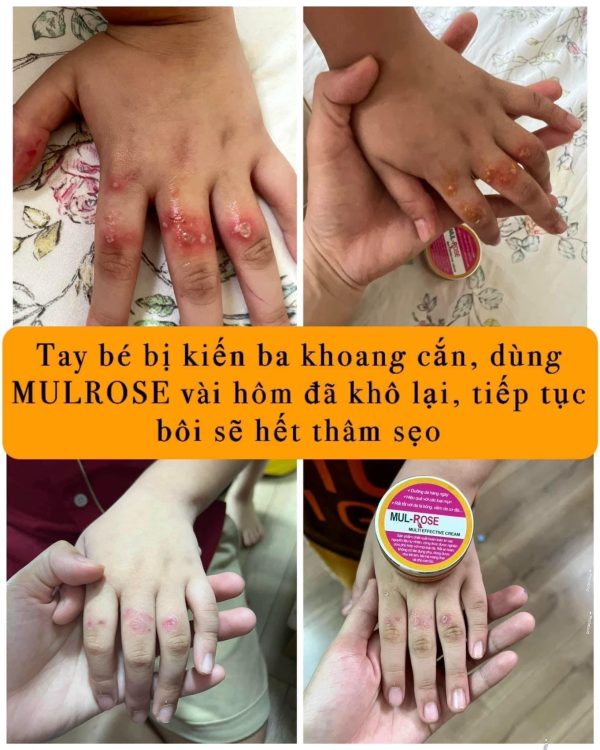 Effects of mui rose cream for pregnant women baby kid